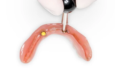 Beispiele: Verlust der Verankerung an Zähne bzw. Implantaten