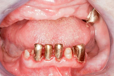 Beispiele: Verlust der Verankerung an Zähne bzw. Implantaten