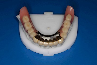 Zahnprothese Beispiele für Verlust der Verankerung an Zähne bzw. Implantaten 